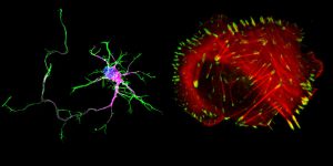 SHANK regulates adhesion and protrusion in very different cell types: cancer cells and neurons. This image, taken by Dr. Guillaume Jacquemet, reveals the distinct morphologies of neurons and cancer cells. On the right: a primary rat hippocampal neuron stained for actin (green), DAPI (blue) and MAP2 (purple). On the left: a bone cancer cell stained for actin (red) and paxillin (green). Photo credit: Turku Centre for Biotechnology.